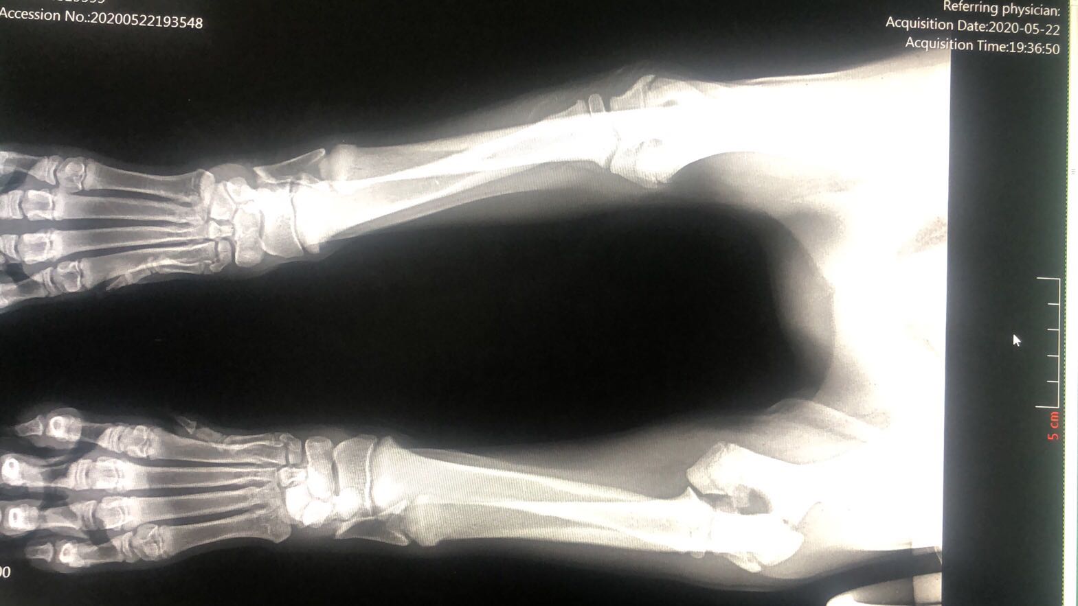 關(guān)節(jié)肘頭與冠狀骨斜骨折。經(jīng)兩個(gè)小時(shí)手術(shù)，將斷骨聯(lián)結(jié)