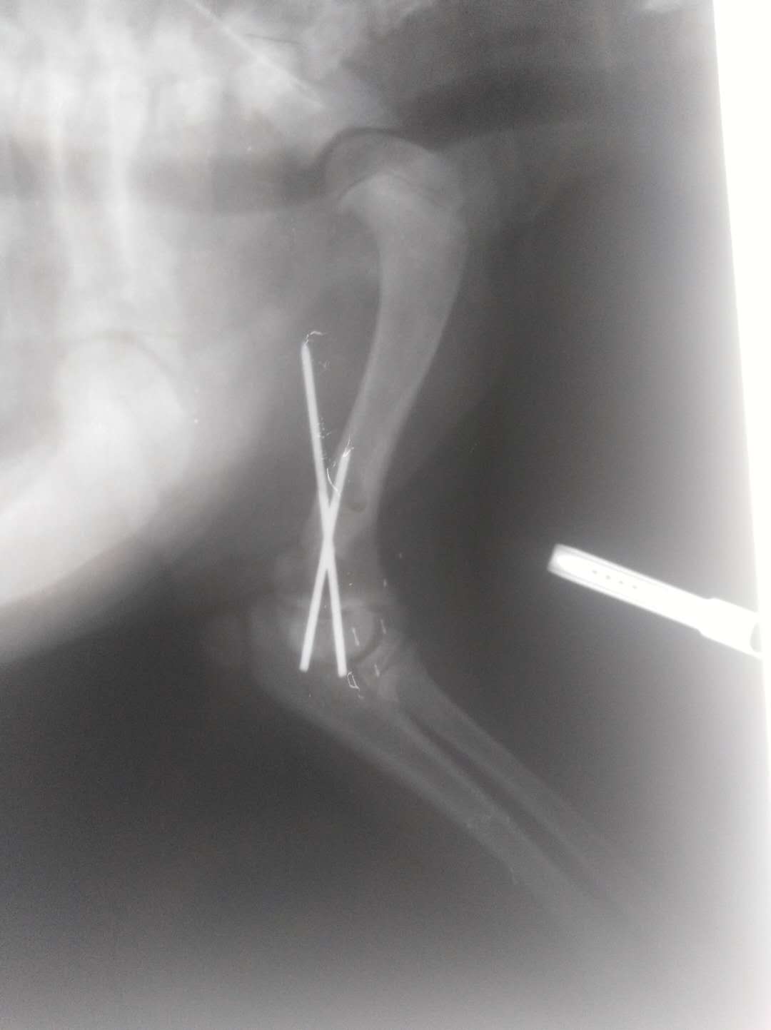 關(guān)節(jié)肘頭與冠狀骨斜骨折。經(jīng)兩個(gè)小時(shí)手術(shù)，將斷骨聯(lián)結(jié)